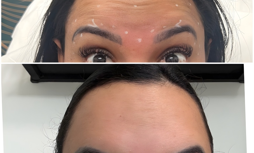 Image 2:  Maintain Youthful Skin: 20 or 40  Units of Jeuveau - 1 or 3 Sessions