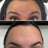 Image 2:  Maintain Youthful Skin: 20 or 40  Units of Jeuveau - 1 or 3 Sessions