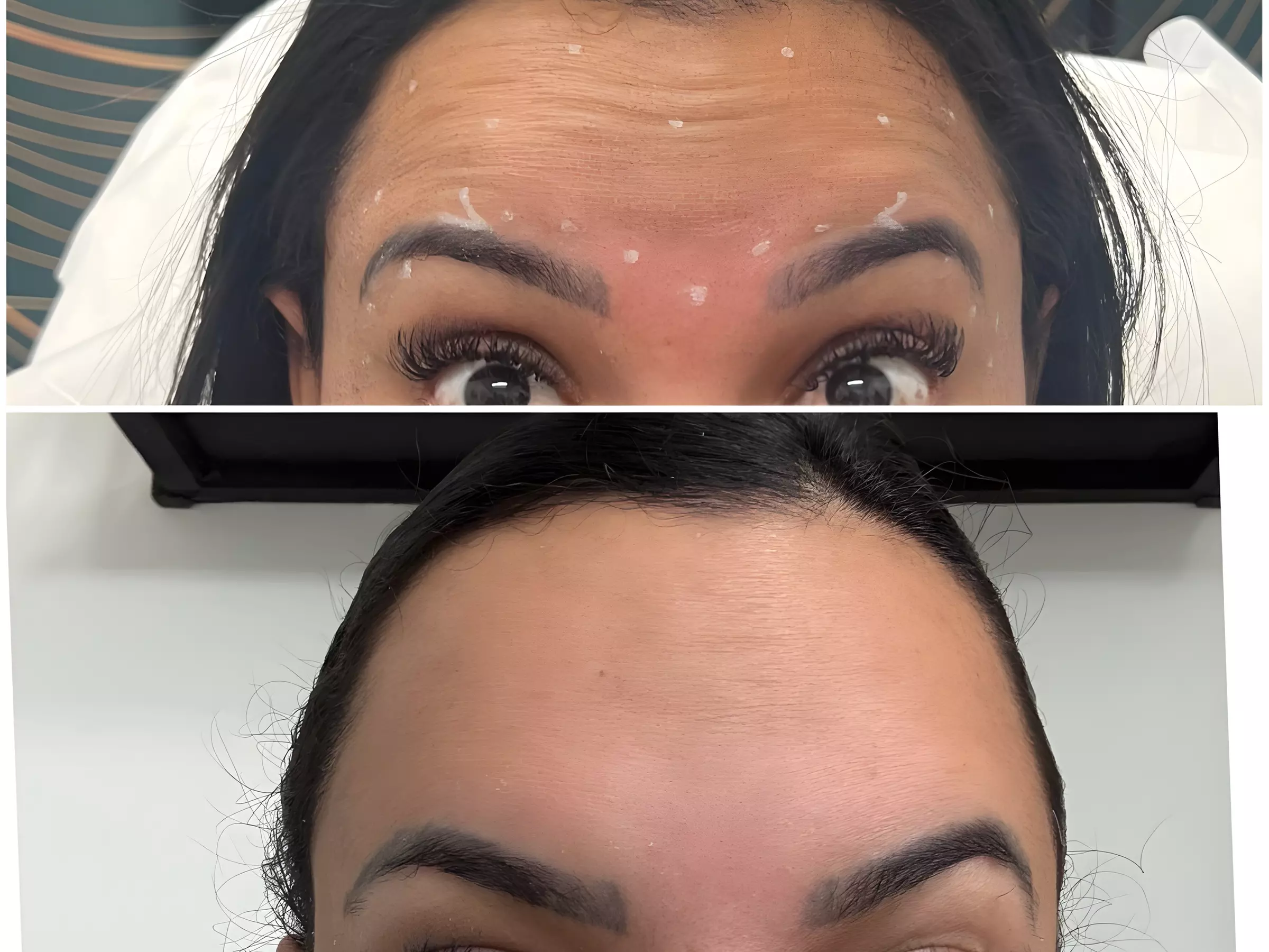  Maintain Youthful Skin: 20 or 40  Units of Jeuveau - 1 or 3 Sessions