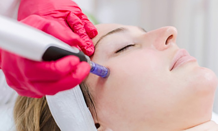 Achieve Smoother Skin with Microneedling Options Available