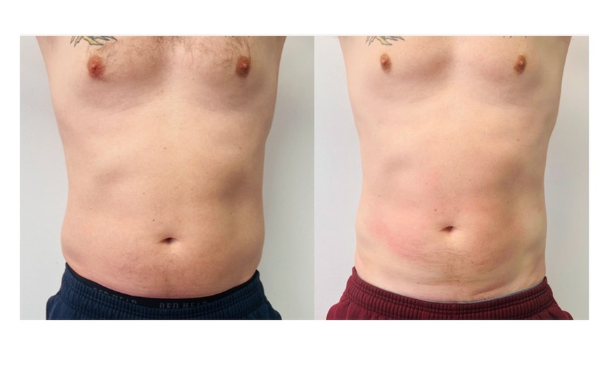 Image 5: Choose from various non-invasive laser lipo options