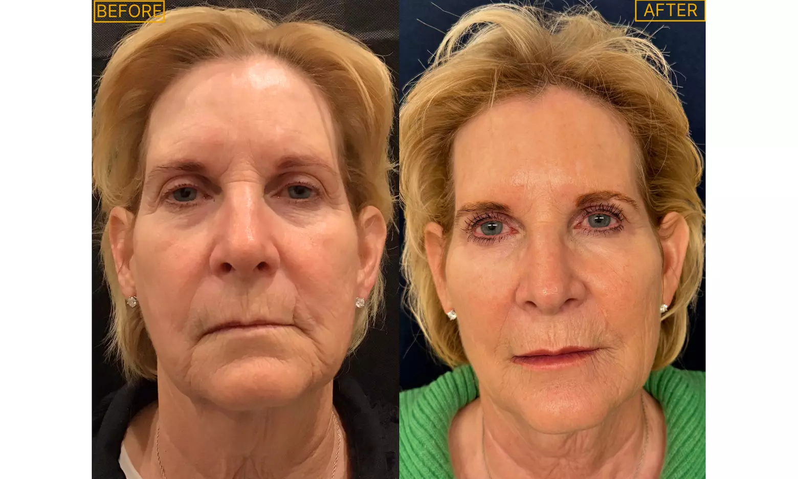 Get a Smoother Look with Botox for Frown Lines or Crows Feet