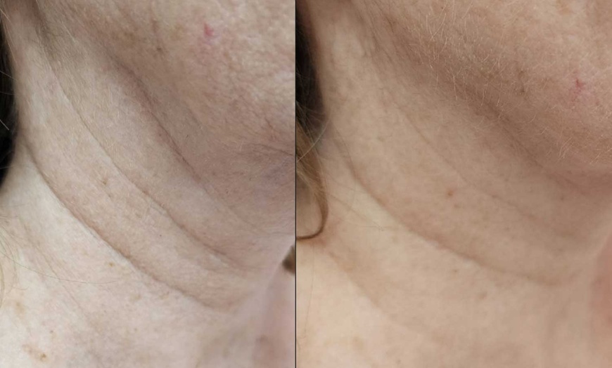 Image 3: Non-Surgical HIFU Chin Reduction, Face Lift with Neck Lift Add On!