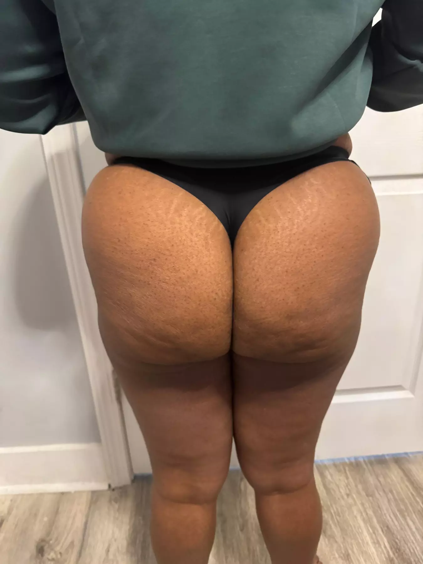 Up to 41% Off on Dermal Filler at Massage World Medspa