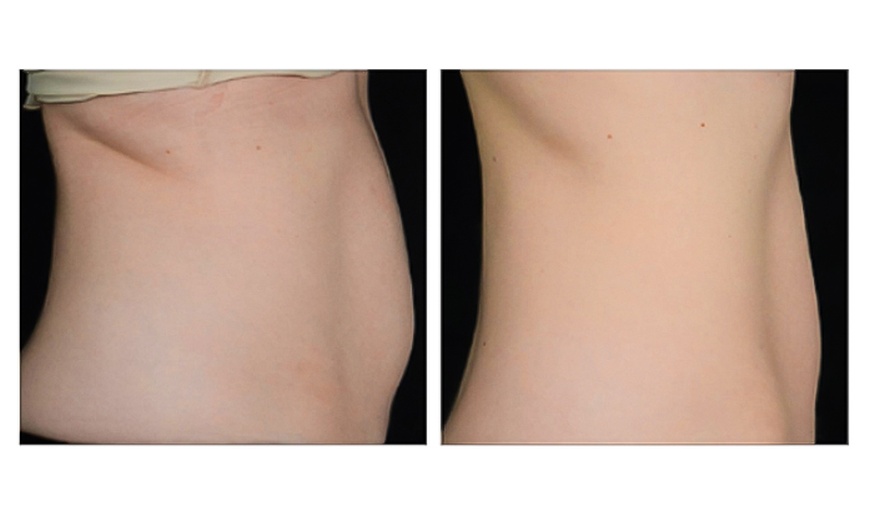 Image 3: Ultrasonic Fat Reduction at Ethereal Rejuvenation Clinic