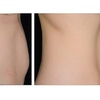 Image 3: Ultrasonic Fat Reduction at Ethereal Rejuvenation Clinic