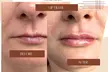 Perfect Your Pout with Dermal Filler - 0.5ml or 1ml  (Up To 60% Off) - Image 7