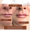 Image 7: Define Your Lips with Expertly Applied 0.5ml or 1ml Dermal Filler 