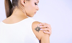 Tattoo Removals in Pretoria