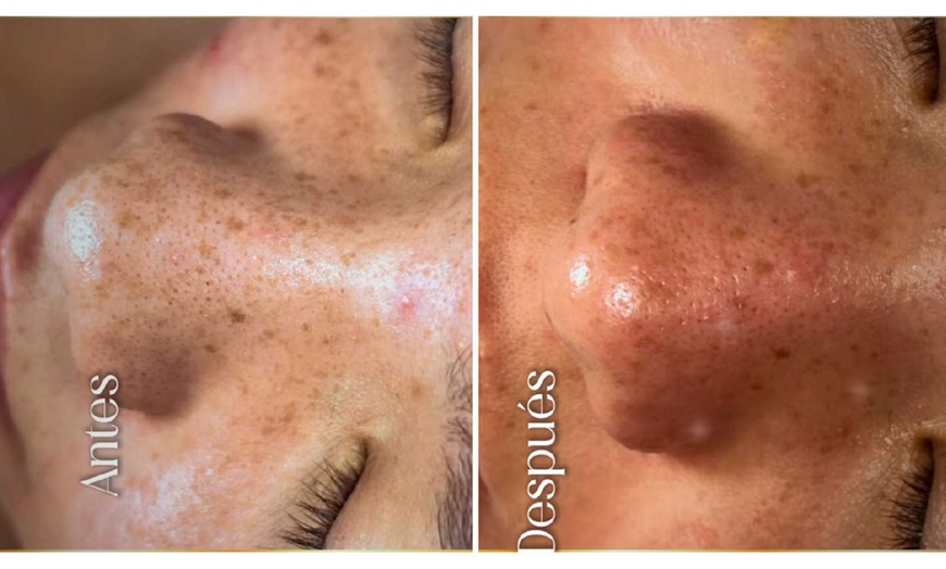 Image 2: Limpieza facial con opción a hydrofacial y tratamiento específico 