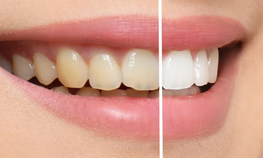 Image 2: Blanqueamiento dental con led en Clínica Dental Odontoss