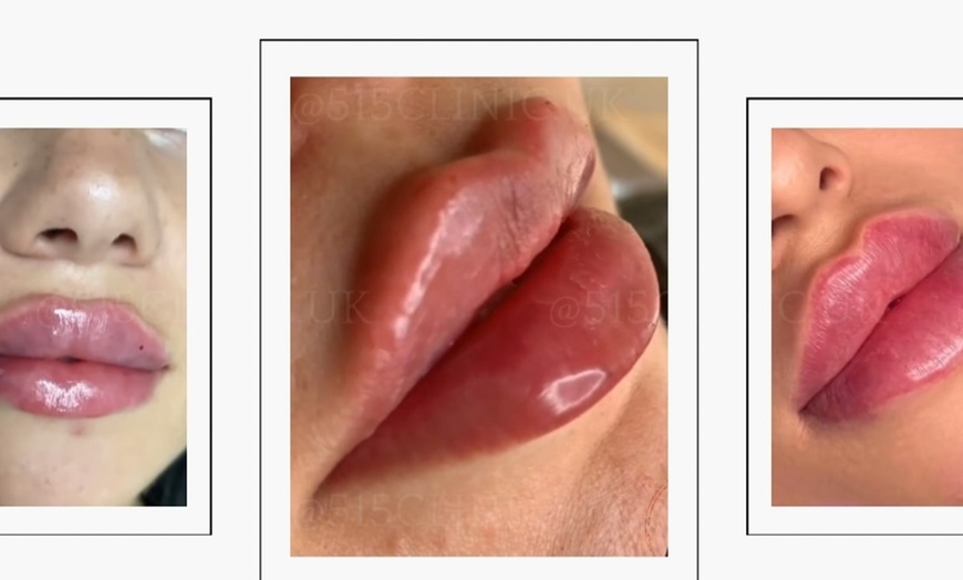 Image 2: Achieve a Natural Look with Dermal Filler 0.5ml, 1ml, or 2ml