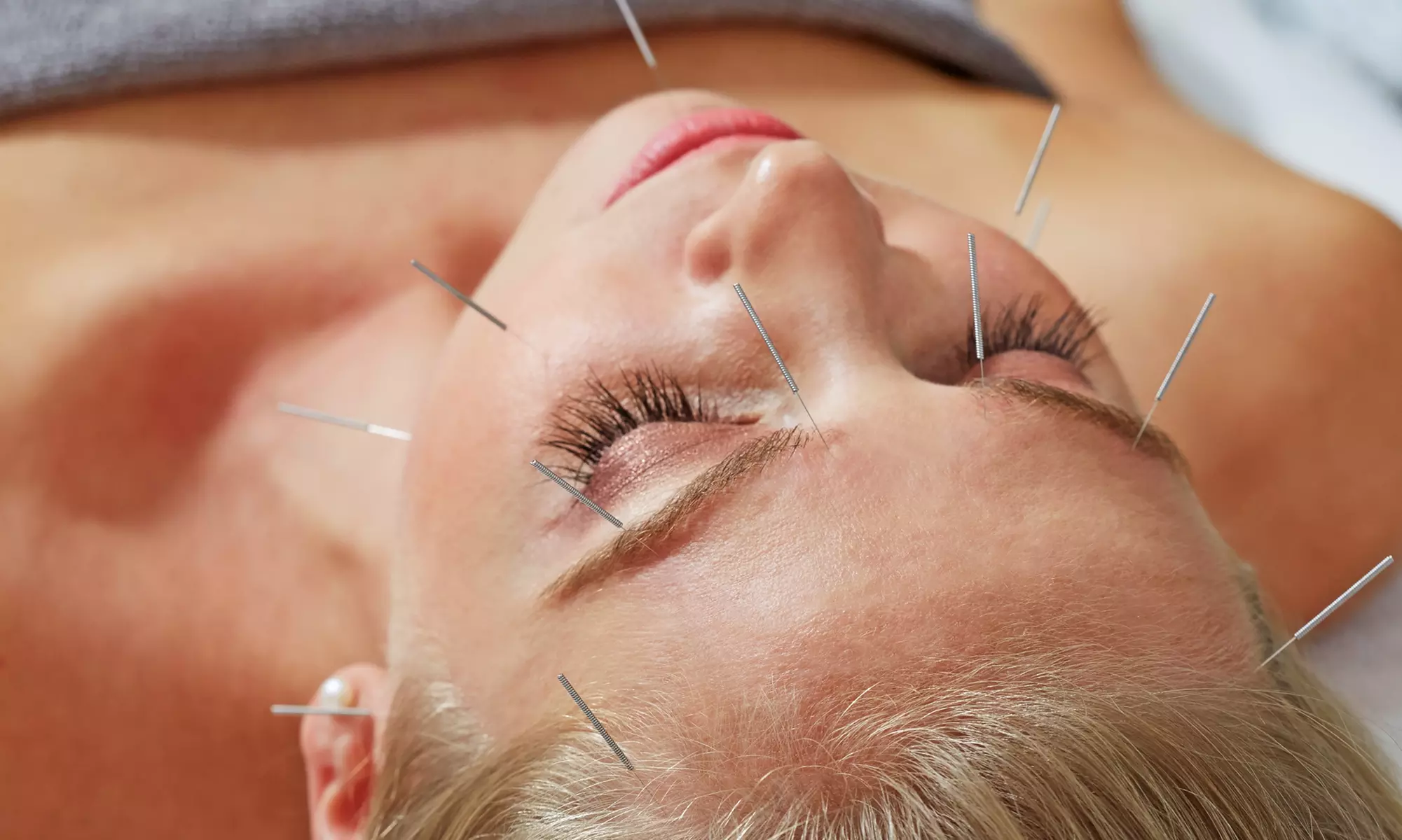 Experience Madison's Family Wellness with 1 to 5 Acupuncture Sessions, up to 50% off - Primary Image