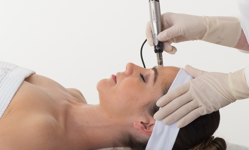 Image 5: Peel or Microneedling