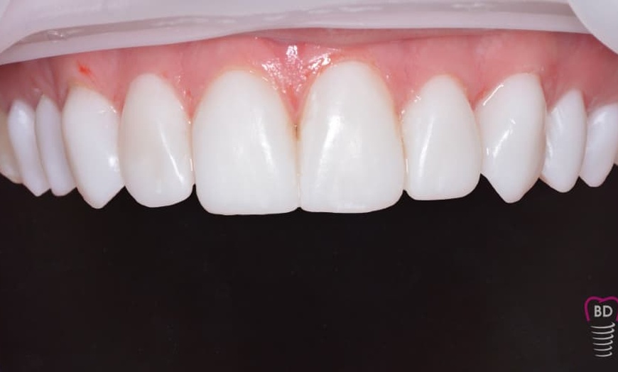 Image 5: Teeth Cleaning, Scaling and Polish at Bespoke Dental & Implant Clinic