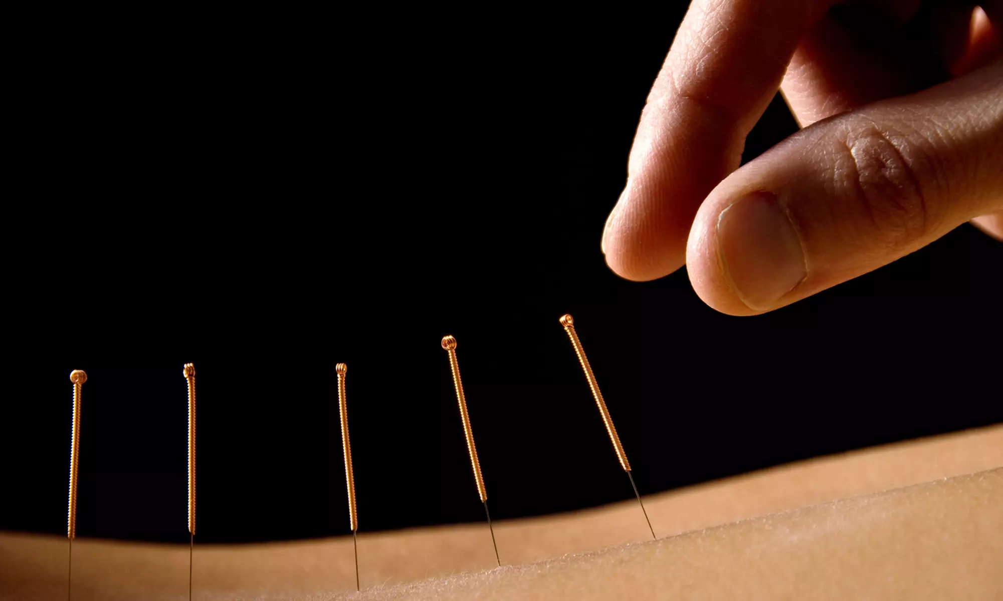 One or Three Acupuncture Sessions at West Meet East Holistic Therapy & Acupuncture Clinic (Up to 77% Off) - Primary Image