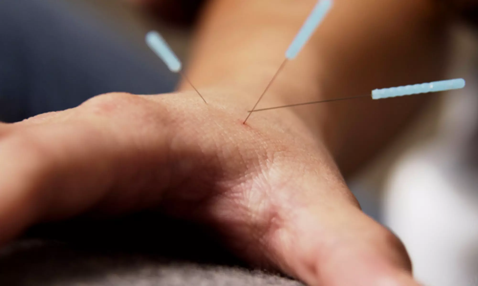 Two or Four Community Acupuncture Treatments at Black Sheep Community Acupuncture, LLC﻿ (Up to 57% Off)  - Primary Image