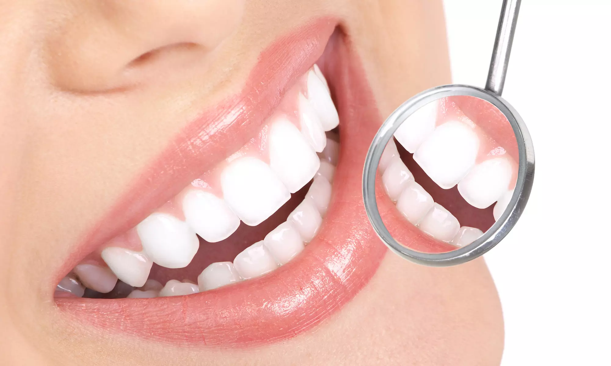 $99 for an Exam, Four X-rays, Cleaning, and Whitening Pen from Smile Dental Care (Up to $288 Value) - Primary Image