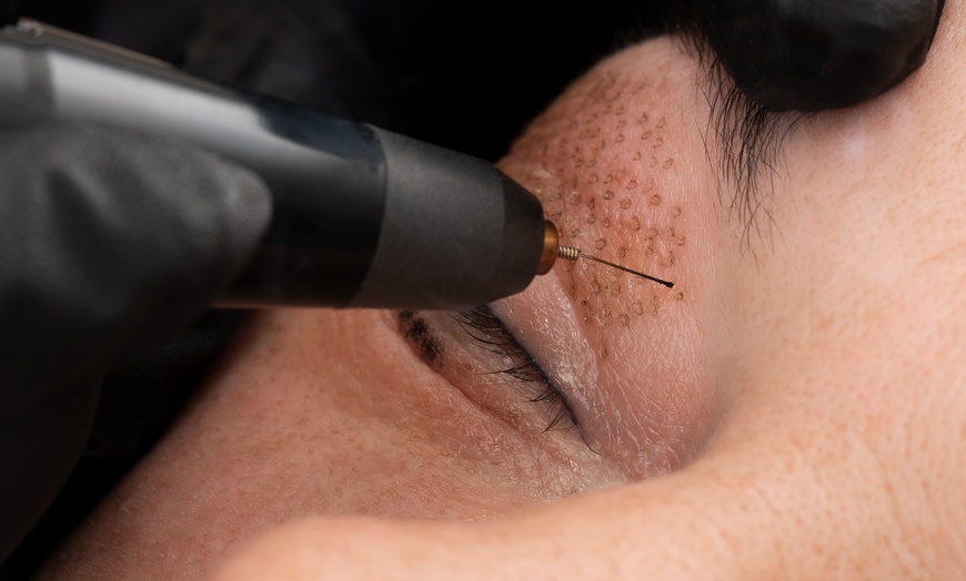 Image 1: Fibroblast Skin Tightening at A and C Hair and Beauty and Aesthetics