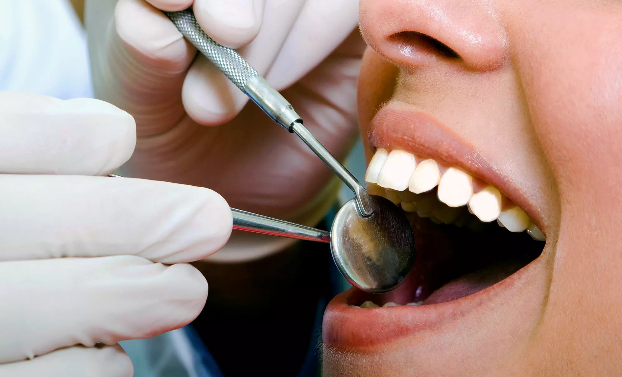 $498 for $995 Worth of Lumineers or Porcelain Veneers - Primary Image