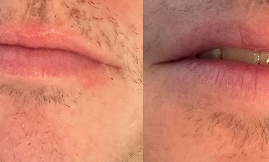 Image 4: Get One or Three Sessions of Hydra Gloss Lips with Hydrapen