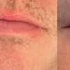Image 4: Get One or Three Sessions of Hydra Gloss Lips with Hydrapen