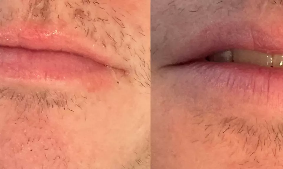Get One or Three Sessions of Hydra Gloss Lips with Hydrapen