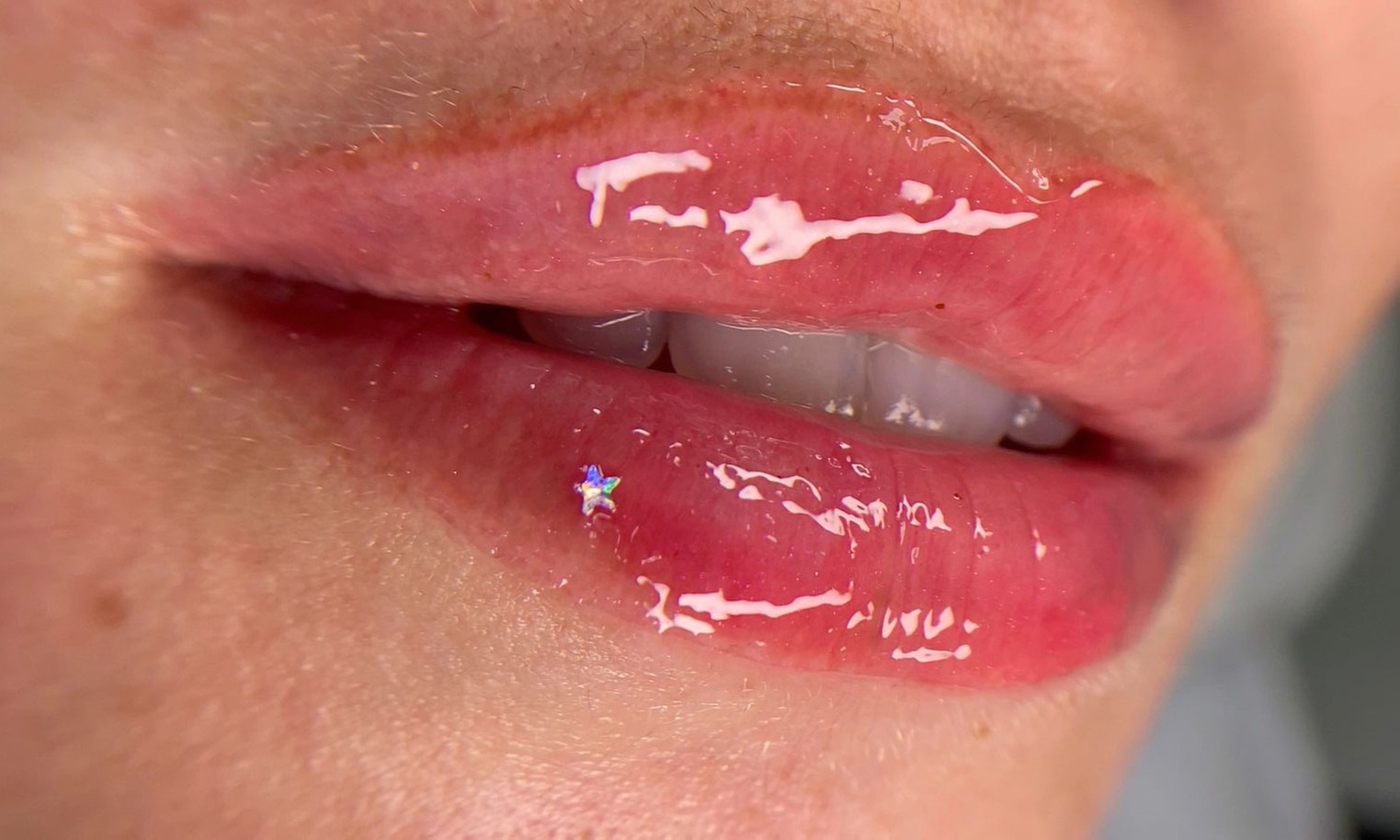 Get One or Three Sessions of Hydra Gloss Lips with Hydrapen