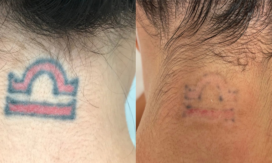 Image 5: Three Sessions of Laser Tattoo Removal: Small, Medium, or Large Area