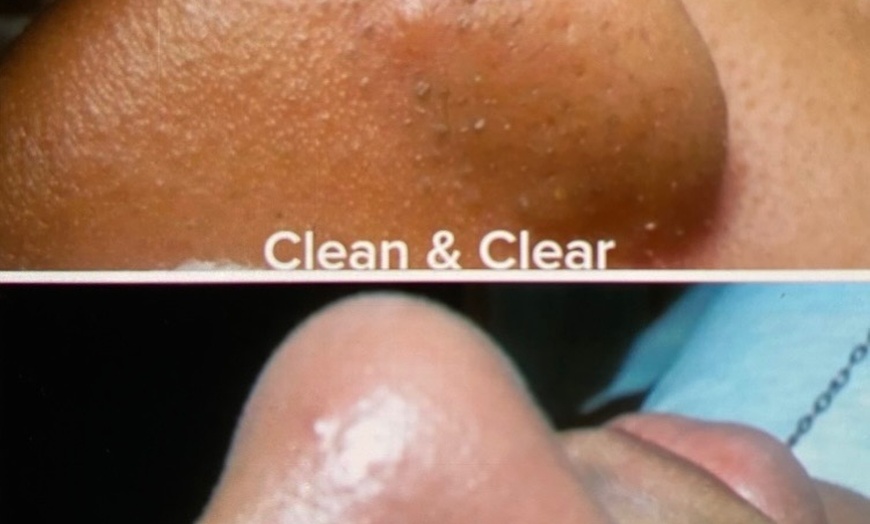 Image 3: One or Two 75 Min Deep Cleansing Facial + Microdermabrasion and More