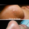 Image 3: Deep Cleansing Facial + Microdermabrasion