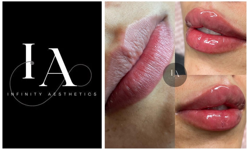 Image 4: Enhance Your Lips with 1.1ml Filler and Expert Consultation