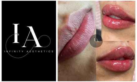 1.1ml Lip Filler with consultation (Russian Lips, Dolls Lips, Signature Lips) - Infinity Aesthetics London