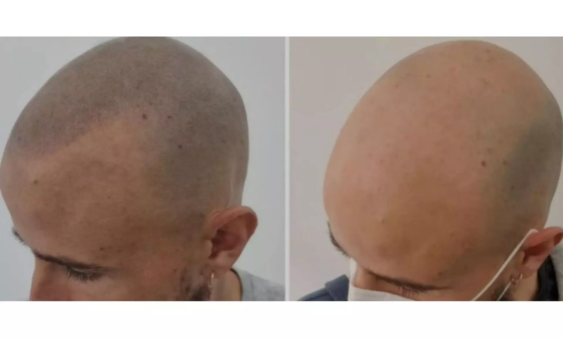 Micropigmentación de labios acuarela, eyeliner, cejas o capilar SMP