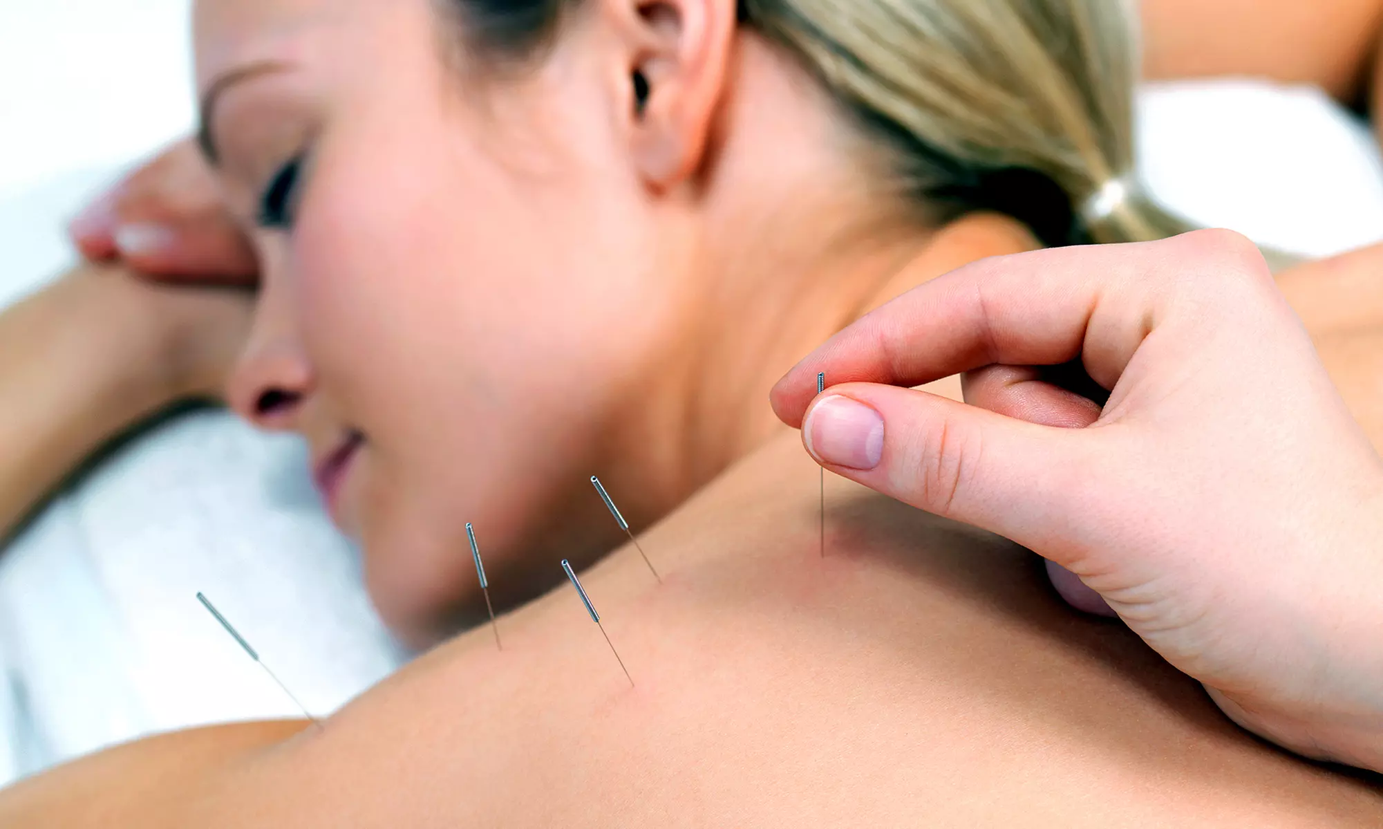 Achieve Wellness @ The Beauty & Holistic Centre's 1, 3, or 5 Acupuncture Sessions + Consultation (Up to 52% Off) - Primary Image