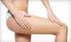 One or Two Sclerotherapy Treatments, or Two or Four Laser Spider-Vein Treatments at Advanced Vein Center (Up to 85% Off)