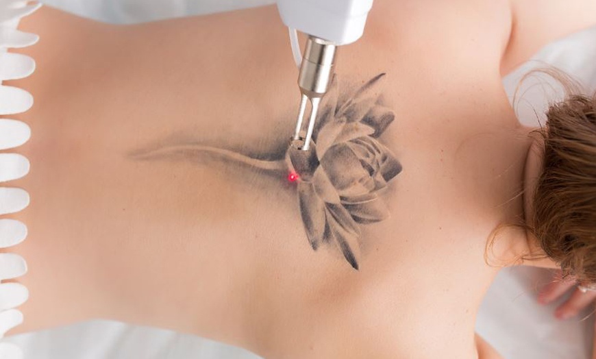 Image 1: Laser Tattoo Removal