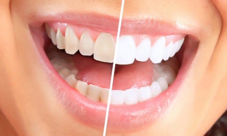 Up to 61% Off on Teeth Whitening - In-Office - Branded (Zoom, Brite Smile) at Royal Beauti Bar