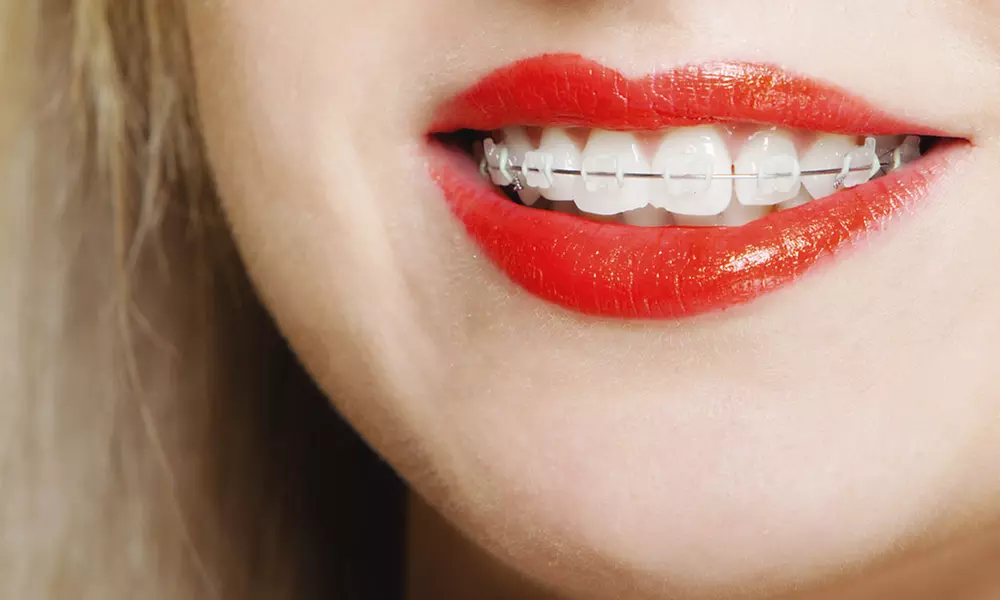 Ortodoncia con brackets metálicos, de porcelana o de zafiro y 6 revisiones desde 249 € en Clínica Dental Goya, 116 - Primary Image