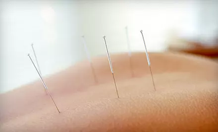 One 60-Minute Acupuncture Treatments or Three 30-Minute Treatments at Zen Clinic of Natural Therapy (Up to 67% Off) - Primary Image