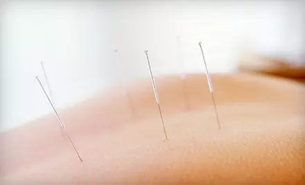 $39 for a Choice of Massage, Chiropractic, or Acupuncture Treatment at Glendale Chiro Care (Up to $125 Value) - Primary Image