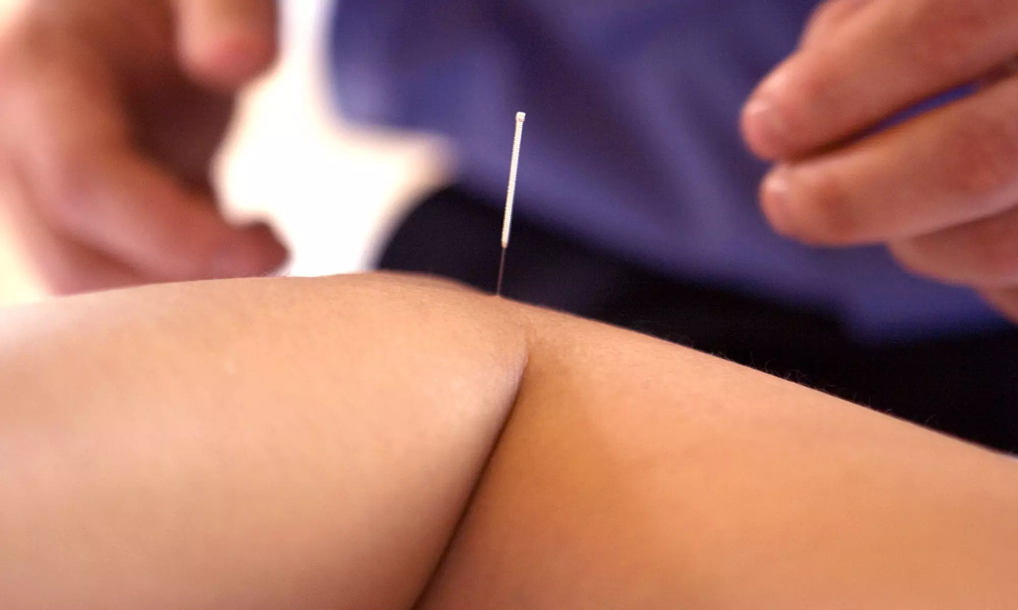$40 for a 60-Minute Acupuncture Session at Calm Spirit Acupuncture ($80 Value) - Primary Image