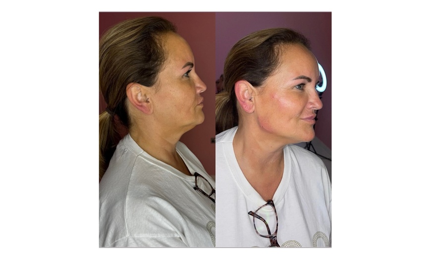 Image 2:  Perfect Contour with 1ml or 2ml Revolax Dermal Filler 