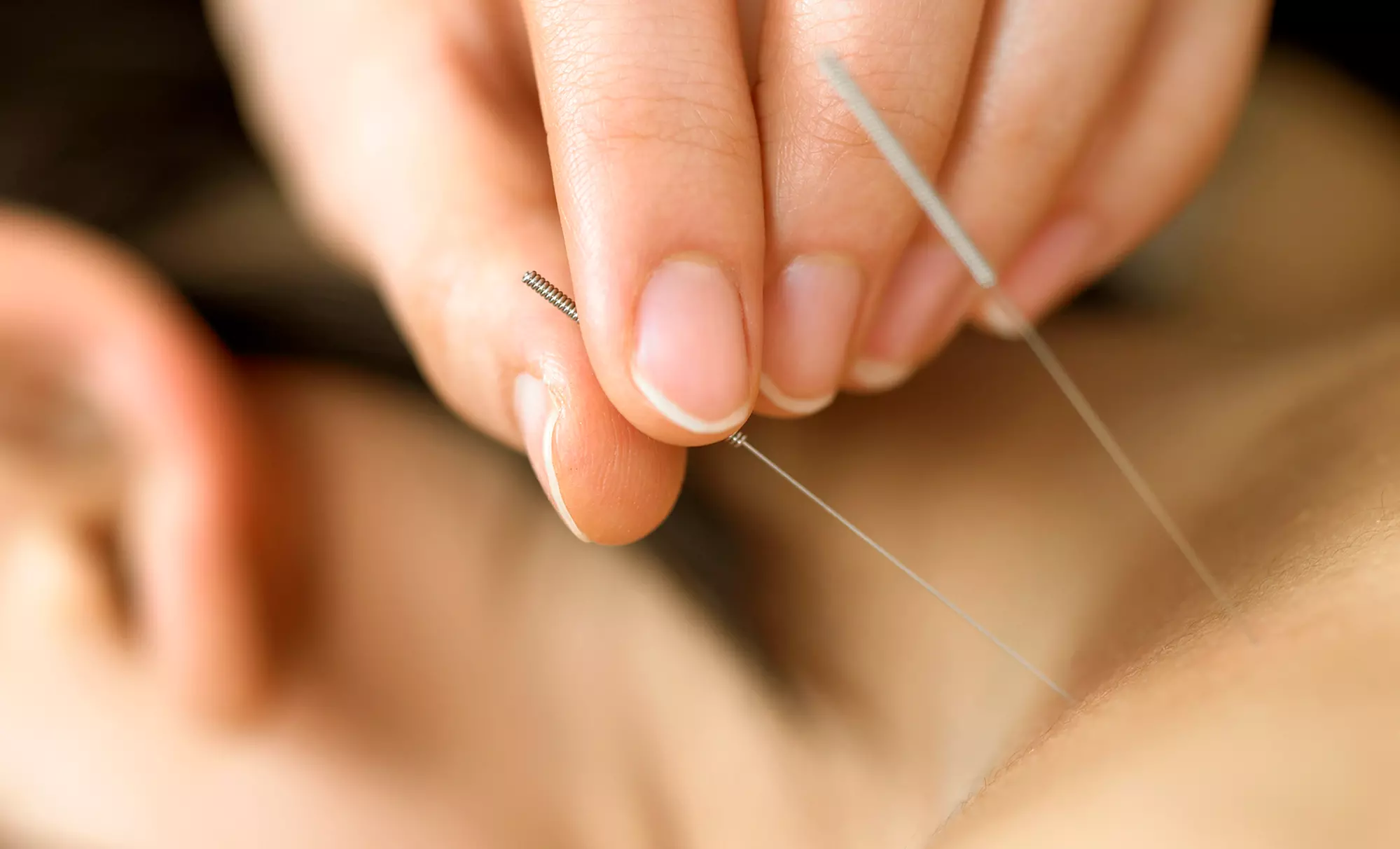 45-Minute Acupuncture Session from Dr. Russell S. Baum D.O.M. (64% Off) - Primary Image