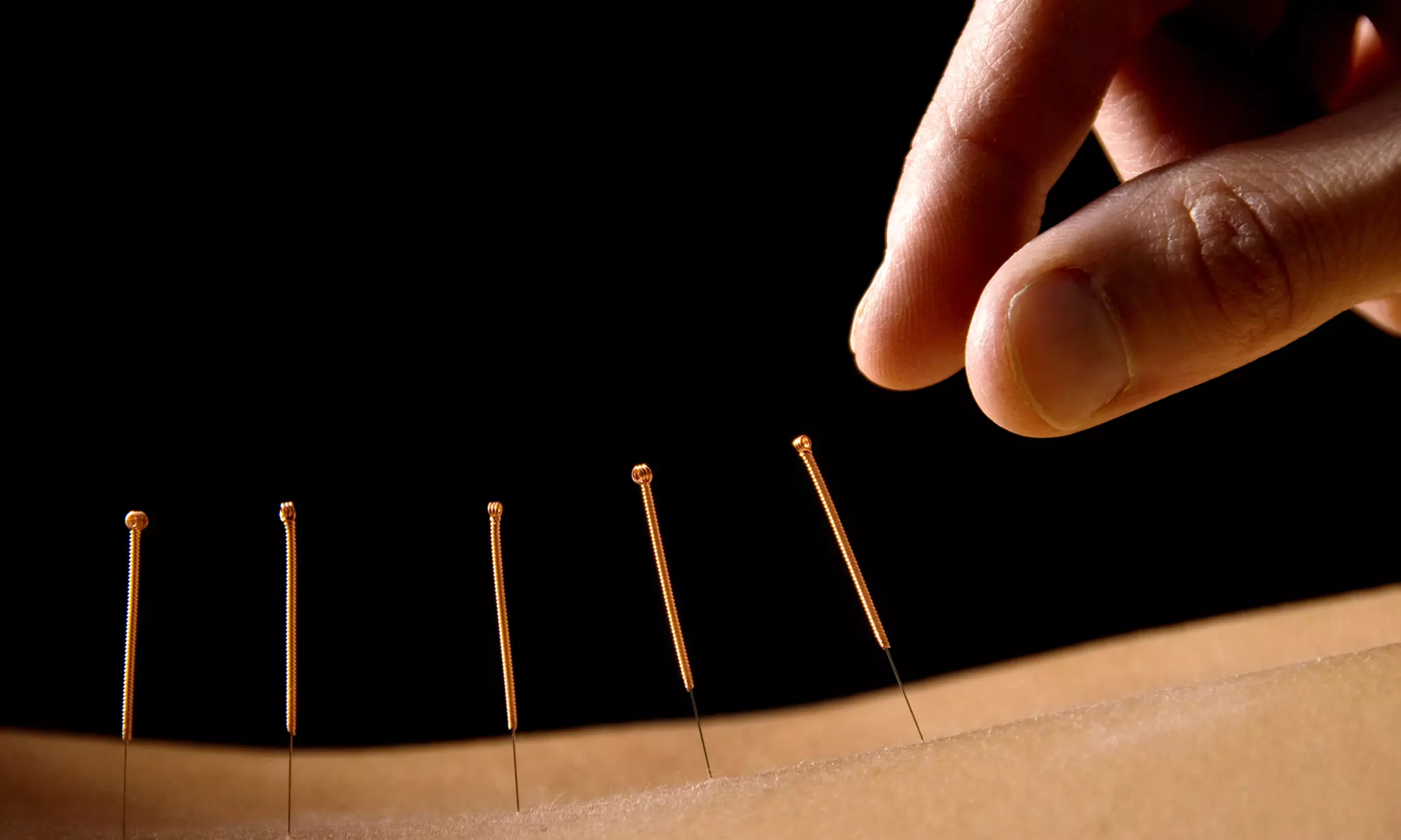 One or Three Acupuncture Sessions at Welland Avenue Chiropractic (Up to 76% Off) - Primary Image