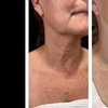 Image 10: Morpheus8 Non-surgical Tightening - Allure Passions Aesthetic Clinic