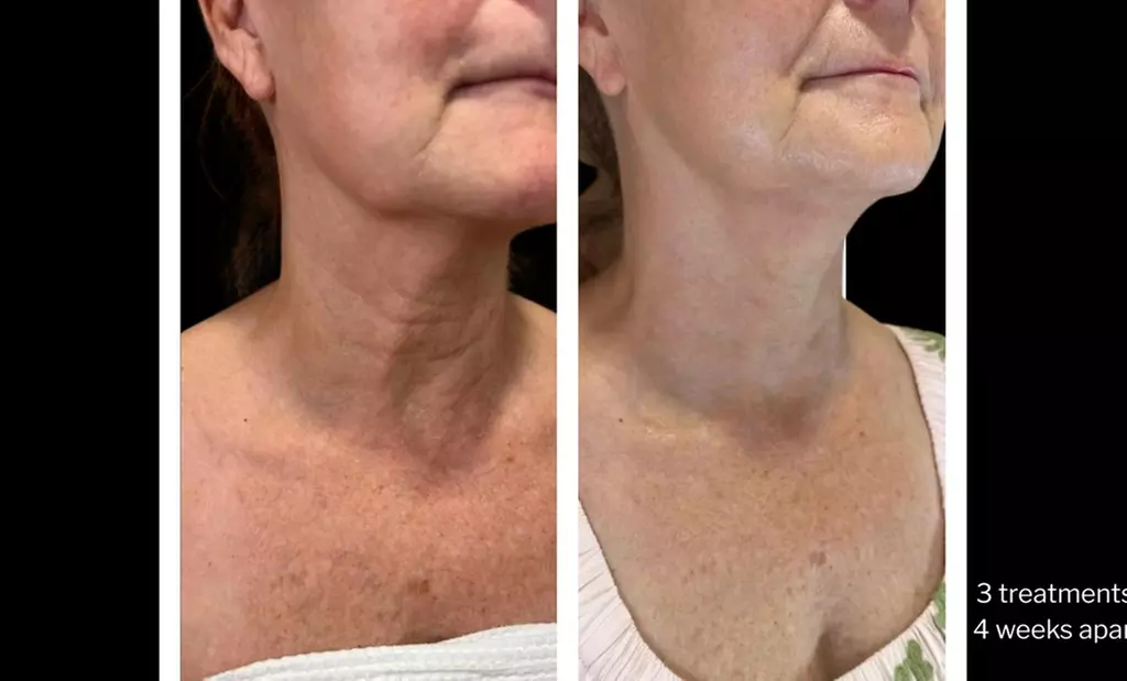 Morpheus8 Non-surgical Tightening - Allure Passions Aesthetic Clinic