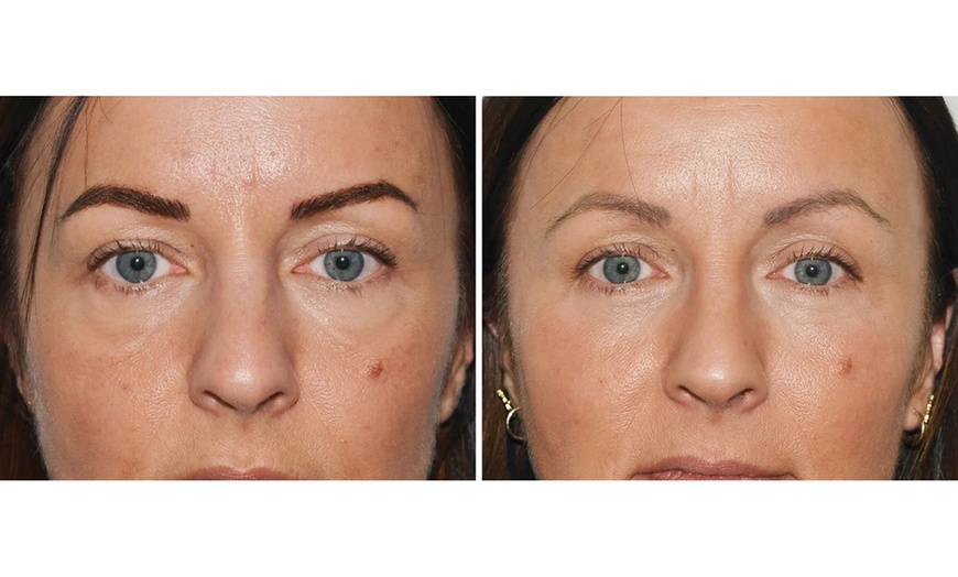 Image 2: One Localized Cryotherapy Session, Eye Bag Removal