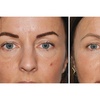 Image 2: One Localized Cryotherapy Session, Eye Bag Removal