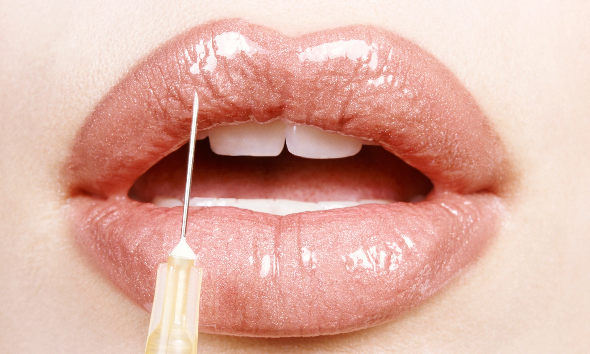Experience Rejuvenation with One Syringe of Juvederm Injection